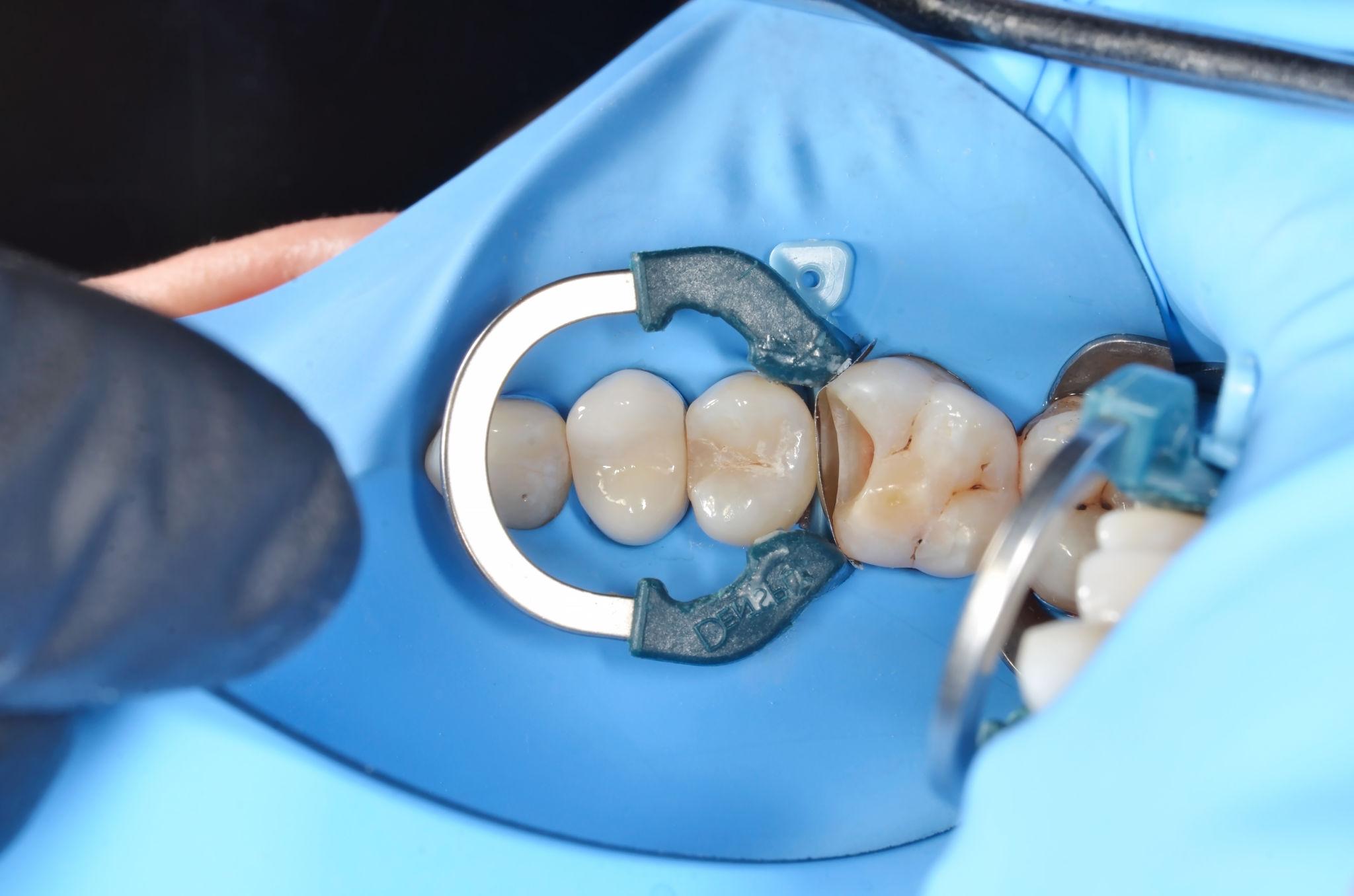 Conservative Composite Restoration